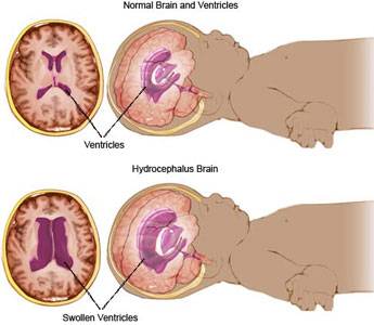 โรคหัวบาตร ไฮโดรเซฟฟาลัส HYDROCEPHALUS