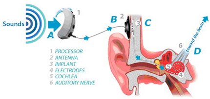 ผ่าตัดฝังประสาทหูเทียม