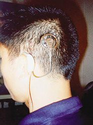 ผ่าตัดฝังประสาทหูเทียม