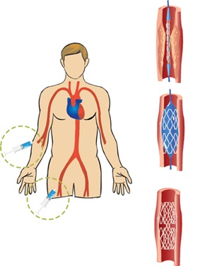 สเต็นท์ stent