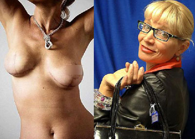 มะเร็งเต้านม