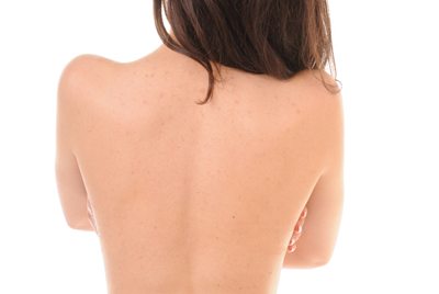 สิวที่หลัง