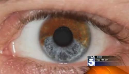 ศัลยกรรม เปลี่ยนสีตา