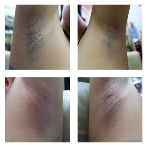 แว็กซ์ขนรักแร้