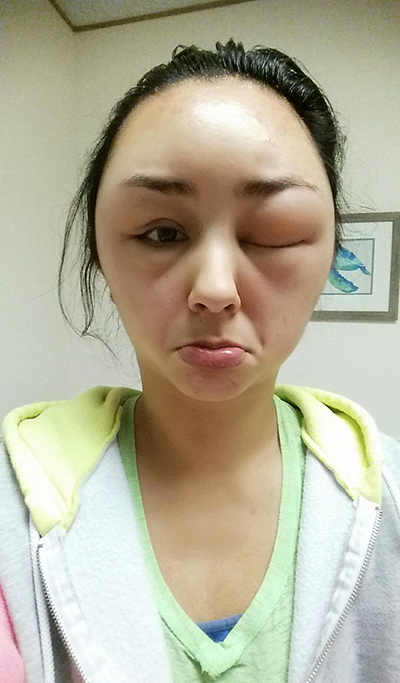 สาวแพ้น้ำยาย้อมผม