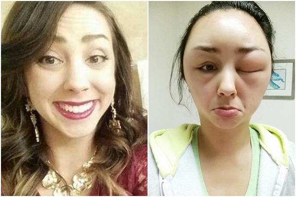 สาวแพ้น้ำยาย้อมผม