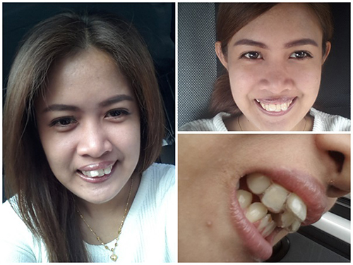 รีวิวจัดฟัน รีวิวจัดฟัน