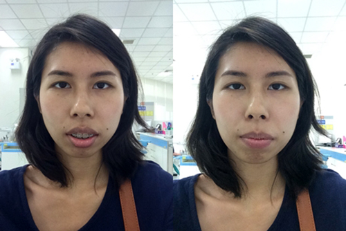 แชร์ประสบการณ์ศัลยกรรม