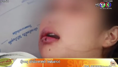 ดัดฟันเถื่อนได้ไม่คุ้มเสีย แพทย์เตือนอย่าตามแฟชั่น เสี่ยงติดเชื้อ