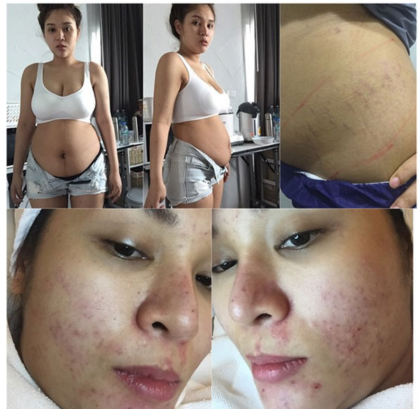 แมลงเมี่ยง ขอทำเพื่อลูก ยอมสิวเขรอะ - หุ่นพัง เปลี่ยนไปเป็นคนละคน