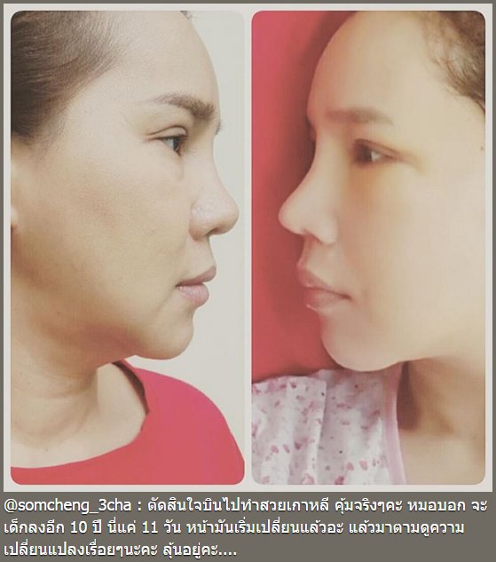 ส้มเช้ง สามช่า ศัลยกรรม