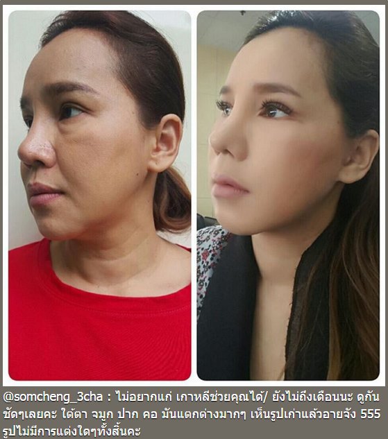 ส้มเช้ง สามช่า ศัลยกรรม