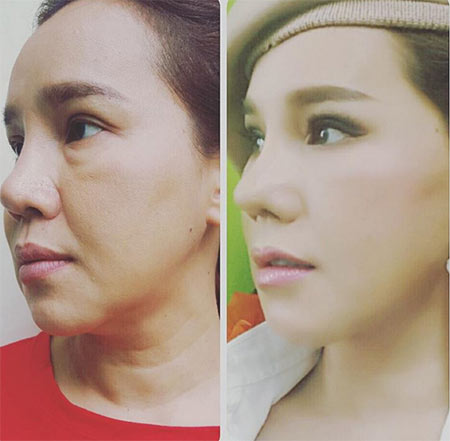 ส้มเช้ง สามช่า ศัลยกรรม