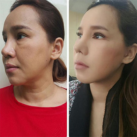 ส้มเช้ง สามช่า ศัลยกรรม