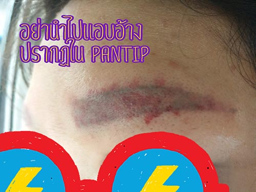 ลบรอยสักคิ้ว