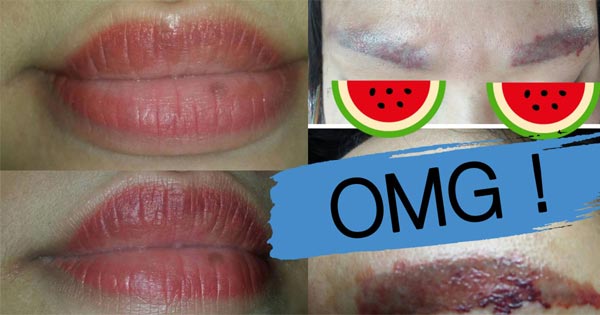 ลบรอยสักคิ้ว