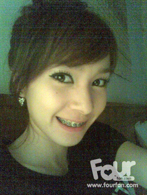 ดาราใส่เหล็กดัดฟัน