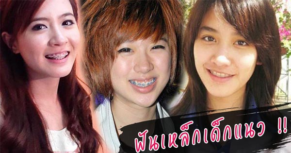 ดาราใส่เหล็กดัดฟัน