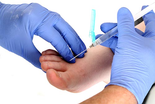 โบท็อกซ์เท้า