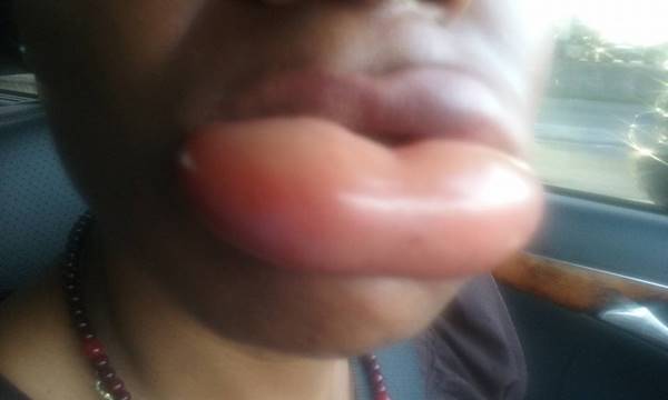 แพ้ลิปสติก