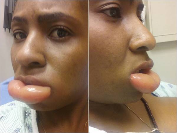 แพ้ลิปสติก