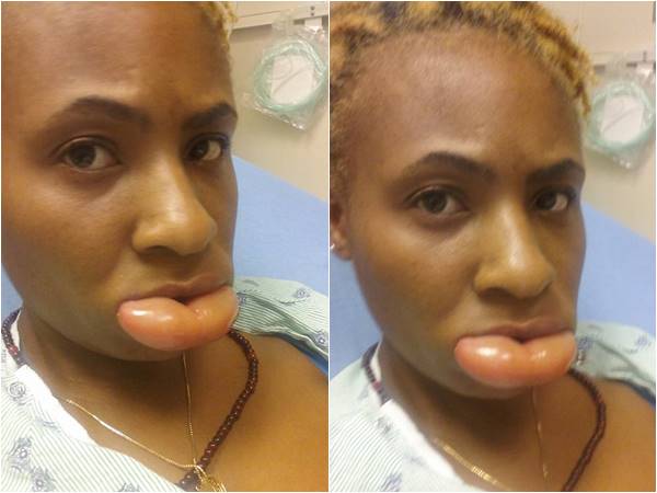 แพ้ลิปสติก