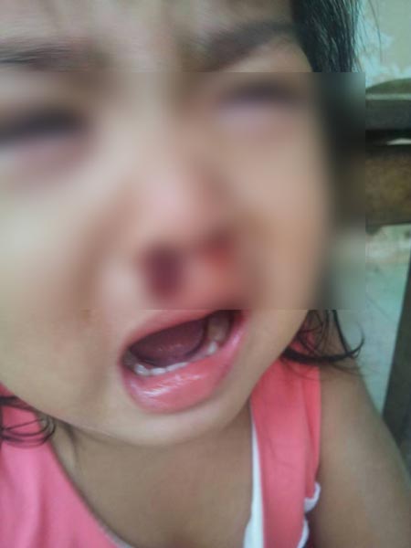 โรคขาดแฟคเตอร์ 7