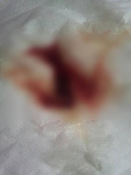 โรคขาดแฟคเตอร์ 7