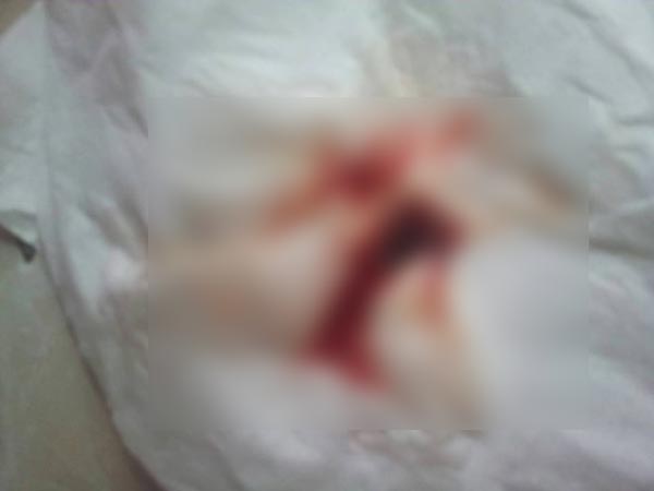 โรคขาดแฟคเตอร์ 7