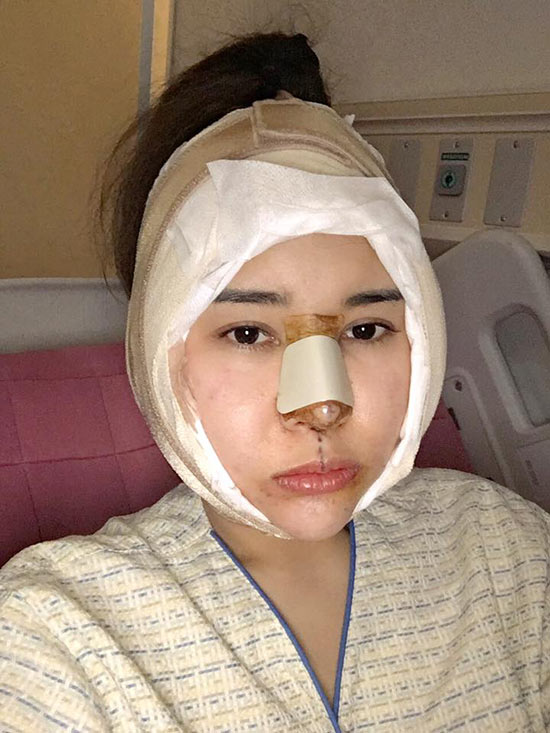 แมลงเมี่ยง บินศัลยกรรมเกาหลี อัพคาง-จมูกใหม่ แฟน ๆ รอชมความสวย