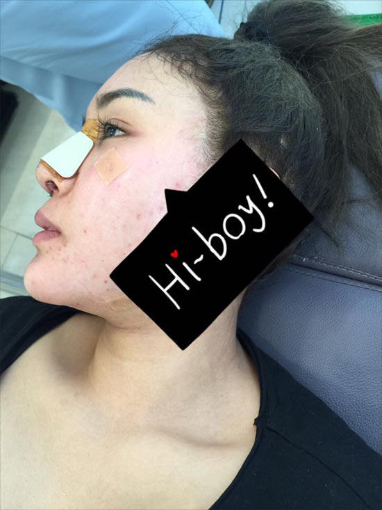 แมลงเมี่ยง บินศัลยกรรมเกาหลี อัพคาง-จมูกใหม่ แฟน ๆ รอชมความสวย