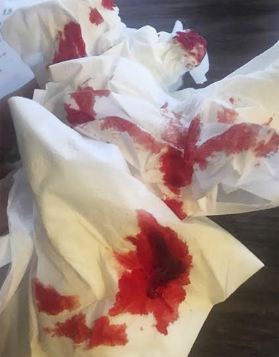 จ๊ะ อาร์สยามเลือดออกปาก ออกจมูก