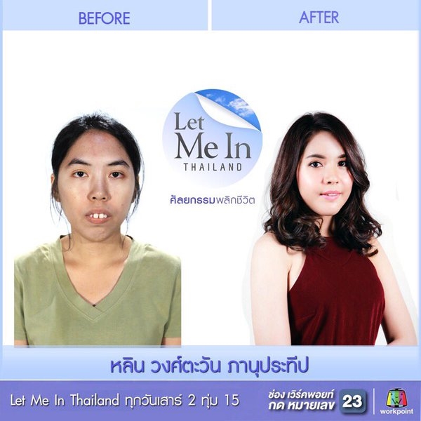 Let Me In Thailand ศัลยกรรมพลิกชีวิต