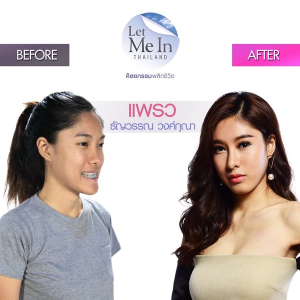 Let Me In Thailand ศัลยกรรมพลิกชีวิต