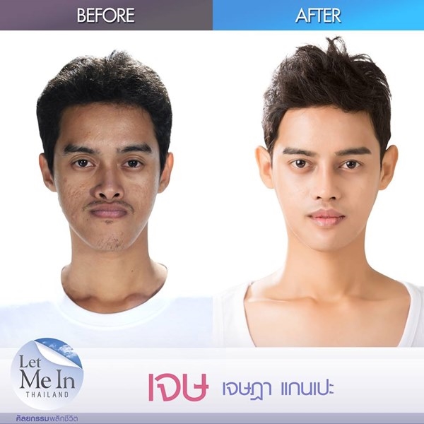 Let Me In Thailand ศัลยกรรมพลิกชีวิต