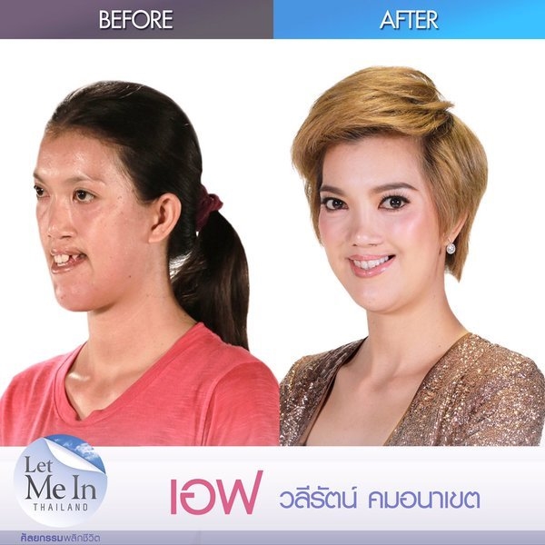 Let Me In Thailand ศัลยกรรมพลิกชีวิต