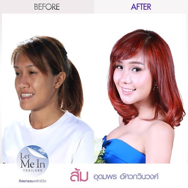 Let Me In Thailand ศัลยกรรมพลิกชีวิต