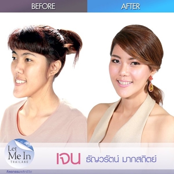 Let Me In Thailand ศัลยกรรมพลิกชีวิต