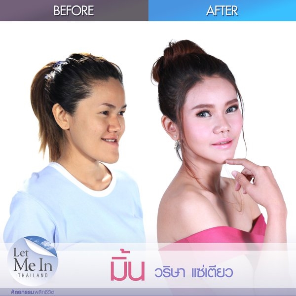 Let Me In Thailand ศัลยกรรมพลิกชีวิต