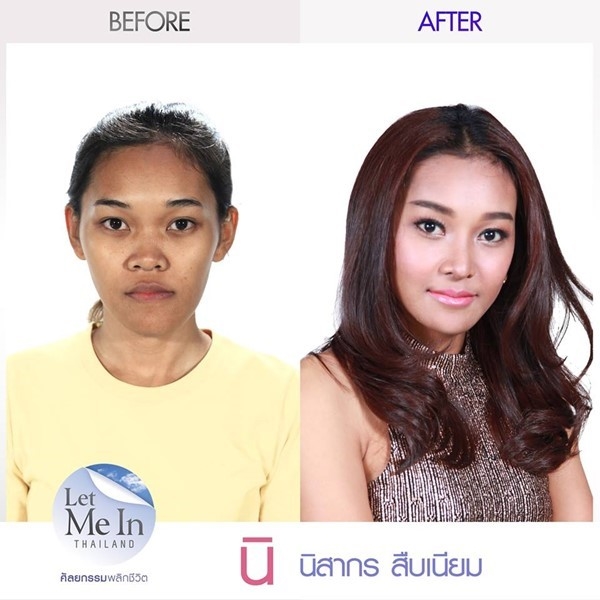 Let Me In Thailand ศัลยกรรมพลิกชีวิต