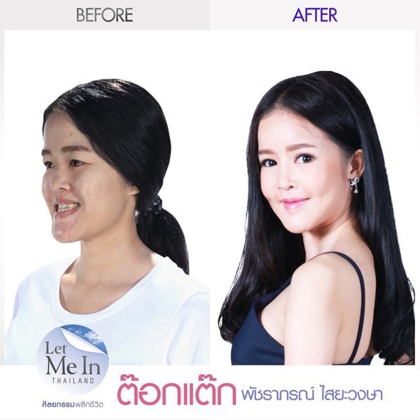 Let Me In Thailand ศัลยกรรมพลิกชีวิต