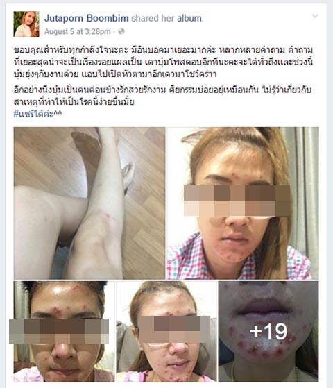 อุทาหรณ์ฉีดผิวขาว ! สาวหน้าสวย แพ้หนัก ตุ่ม-หนองเต็มตัว ผิวเละหัวจรดเท้า