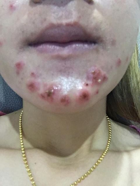 อุทาหรณ์ฉีดผิวขาว ! สาวหน้าสวย แพ้หนัก ตุ่ม-หนองเต็มตัว ผิวเละหัวจรดเท้าอุทาหรณ์ฉีดผิวขาว ! สาวหน้าสวย แพ้หนัก ตุ่ม-หนองเต็มตัว ผิวเละหัวจรดเท้า