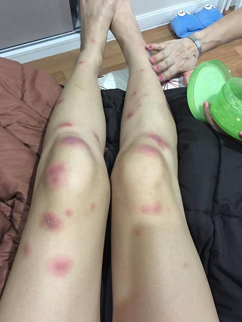 อุทาหรณ์ฉีดผิวขาว ! สาวหน้าสวย แพ้หนัก ตุ่ม-หนองเต็มตัว ผิวเละหัวจรดเท้า