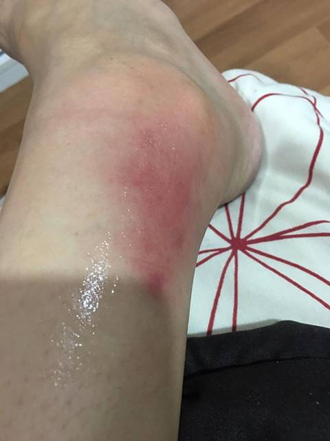 อุทาหรณ์ฉีดผิวขาว ! สาวหน้าสวย แพ้หนัก ตุ่ม-หนองเต็มตัว ผิวเละหัวจรดเท้า