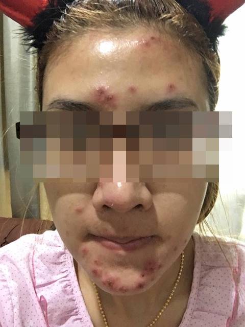 อุทาหรณ์ฉีดผิวขาว ! สาวหน้าสวย แพ้หนัก ตุ่ม-หนองเต็มตัว ผิวเละหัวจรดเท้า