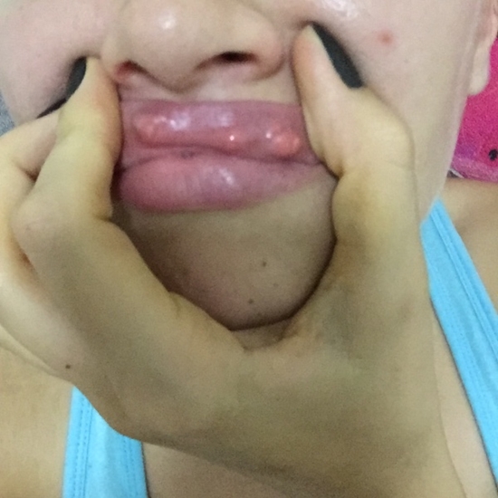 ครูสาวชาวอังกฤษ เจอพิษฟิลเลอร์เถื่อนในกรุงเทพฯ ปากพัง-แฟนทิ้ง