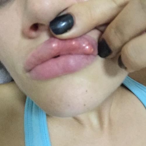 ครูสาวชาวอังกฤษ เจอพิษฟิลเลอร์เถื่อนในกรุงเทพฯ ปากพัง-แฟนทิ้ง