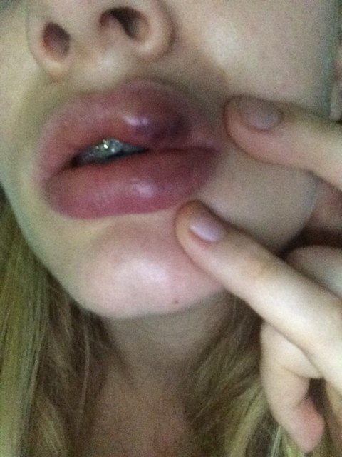 ครูสาวชาวอังกฤษ เจอพิษฟิลเลอร์เถื่อนในกรุงเทพฯ ปากพัง-แฟนทิ้ง