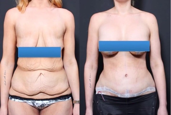 รีวิวลดนํ้าหนัก